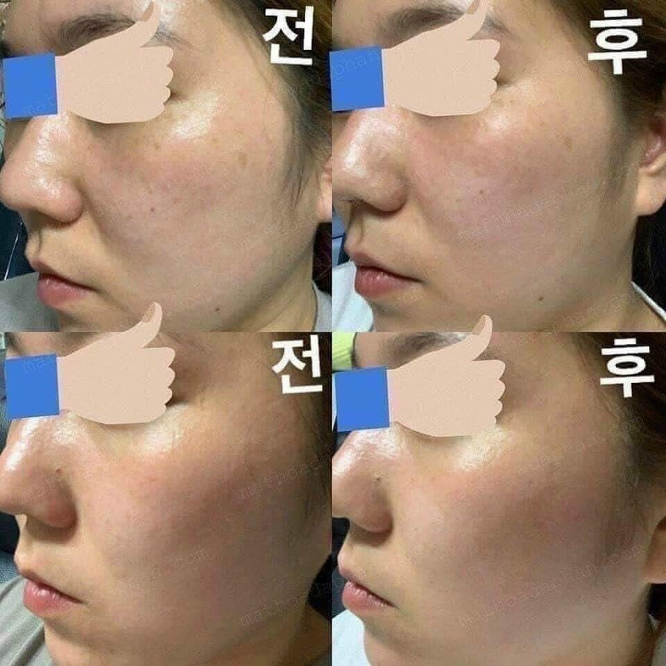 KEM DƯỠNG TRẮNG TRỊ NÁM NHẬT BẢN- TRANSINO WHITENING REPAIR CREAM EX