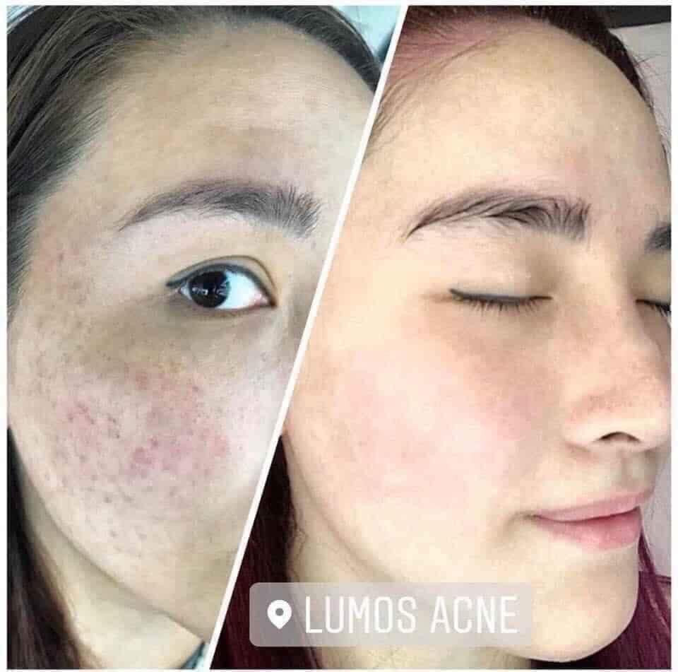 SERUM TRỊ MỤN LUMOS