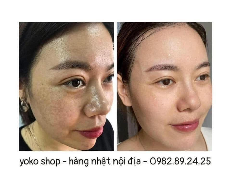 KEM DƯỠNG TRẮNG TRỊ NÁM NHẬT BẢN- TRANSINO WHITENING REPAIR CREAM EX