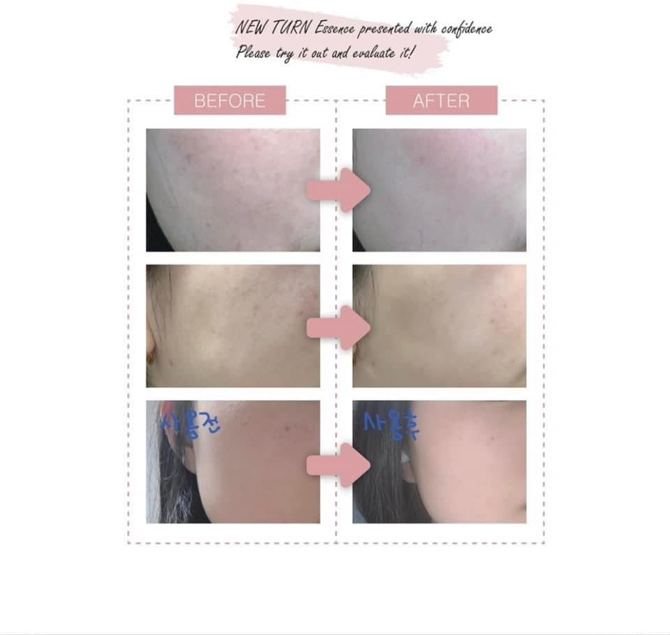 KEM DƯỠNG CHỐNG LÃO HOÁ NMN - NEW TURN