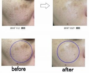 TRANSINO II - VIÊN UỐNG TRỊ NÁM SỐ 1 NHẬT BẢN 🇯🇵